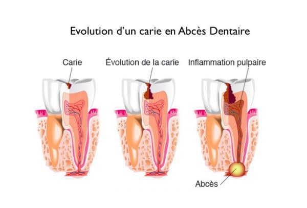 Abcès Dentaire - Cabinet Dentaire du Dr Julien Bucci